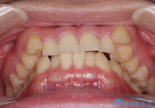 気になる八重歯を抜歯矯正で改善 補助装置を用いたインビザライン矯正の治療前