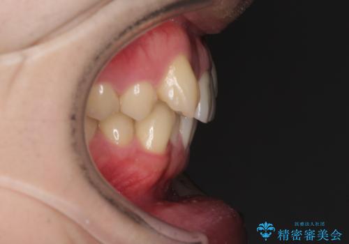 気になる八重歯を抜歯矯正で改善 補助装置を用いたインビザライン矯正の治療前