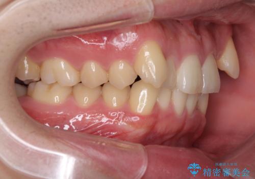 気になる八重歯を抜歯矯正で改善 補助装置を用いたインビザライン矯正の治療前