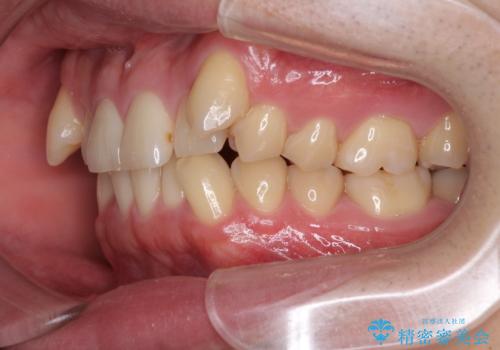 気になる八重歯を抜歯矯正で改善　補助装置を用いたインビザライン矯正の治療前
