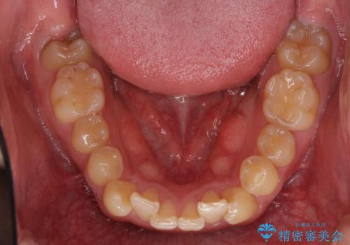 気になる八重歯を抜歯矯正で改善 補助装置を用いたインビザライン矯正の治療前