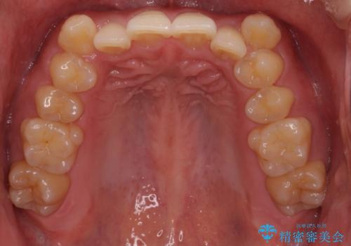 気になる八重歯を抜歯矯正で改善 補助装置を用いたインビザライン矯正の治療前