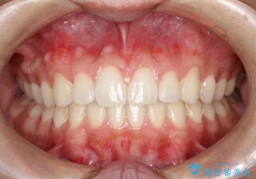 前歯の隙間がきになる　インビザラインですきっ歯の治療の症例 治療後