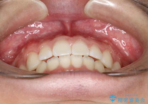 前歯の隙間がきになる インビザラインですきっ歯の治療の治療後