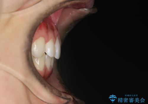 前歯の隙間がきになる インビザラインですきっ歯の治療の治療後