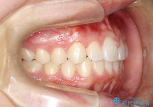 前歯の隙間がきになる インビザラインですきっ歯の治療の治療後