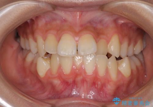 急速拡大装置で狭い歯列を骨格ごと改善 ワイヤー装置による矯正治療の治療前