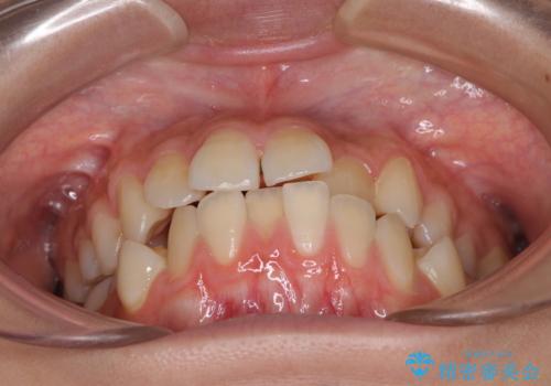 急速拡大装置で狭い歯列を骨格ごと改善 ワイヤー装置による矯正治療の治療前