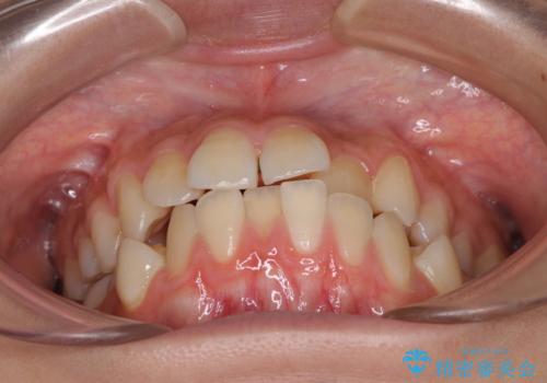 急速拡大装置で狭い歯列を骨格ごと改善　ワイヤー装置による矯正治療の治療前