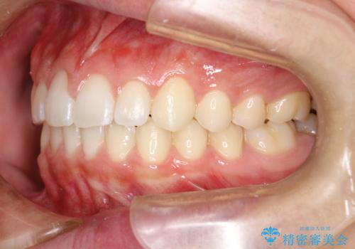 前歯の隙間がきになる　インビザラインですきっ歯の治療の治療後