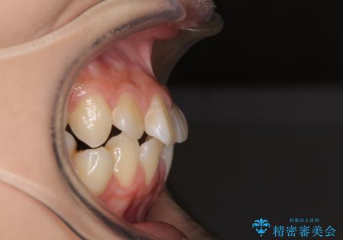 急速拡大装置で狭い歯列を骨格ごと改善 ワイヤー装置による矯正治療の治療前