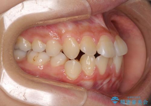 急速拡大装置で狭い歯列を骨格ごと改善 ワイヤー装置による矯正治療の治療前