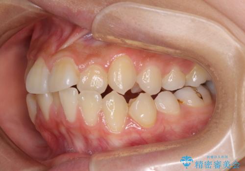急速拡大装置で狭い歯列を骨格ごと改善 ワイヤー装置による矯正治療の治療前