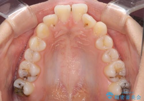 急速拡大装置で狭い歯列を骨格ごと改善 ワイヤー装置による矯正治療の治療前