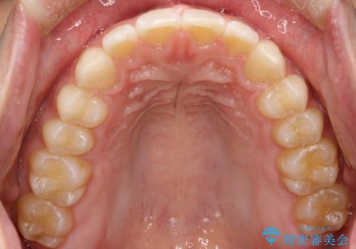 前歯の隙間がきになる インビザラインですきっ歯の治療の治療後