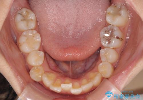 急速拡大装置で狭い歯列を骨格ごと改善 ワイヤー装置による矯正治療の治療前