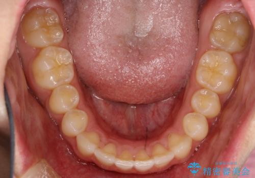 前歯の隙間がきになる インビザラインですきっ歯の治療の治療後