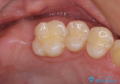 歯に穴を開けられてしまった　インプラントによる奥歯の補綴治療の治療中