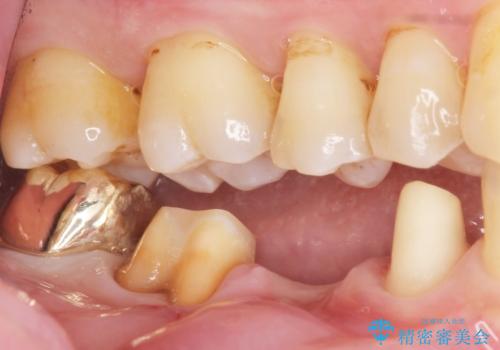 親知らずのせいで隣の歯が虫歯に 40代男性の治療中