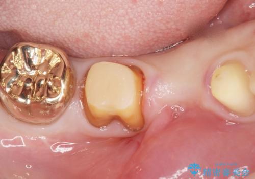 親知らずのせいで隣の歯が虫歯に 40代男性の治療中