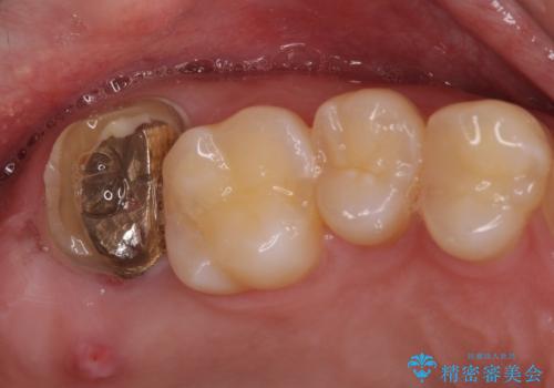 歯に穴を開けられてしまった　インプラントによる奥歯の補綴治療の症例 治療前