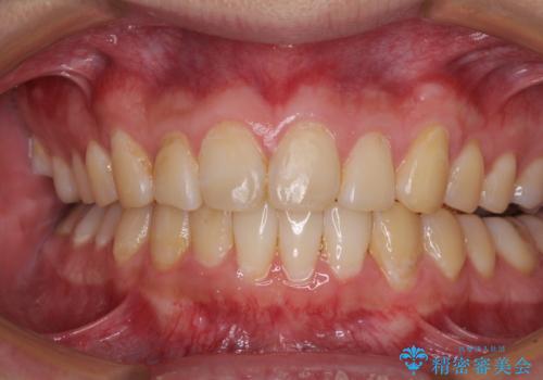 気になる前歯を治したい 短期間でのインビザライン矯正の治療中