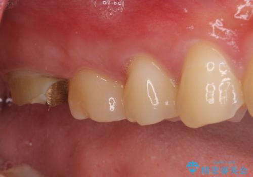 歯に穴を開けられてしまった　インプラントによる奥歯の補綴治療の治療前