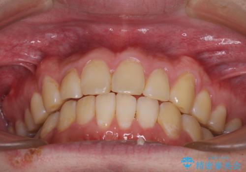 気になる前歯を治したい 短期間でのインビザライン矯正の治療中