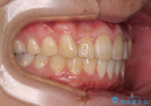 気になる前歯を治したい 短期間でのインビザライン矯正の治療中