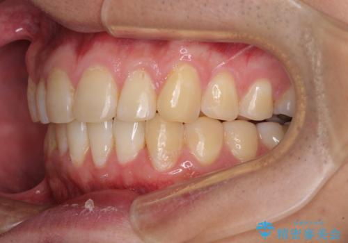 気になる前歯を治したい 短期間でのインビザライン矯正の治療中