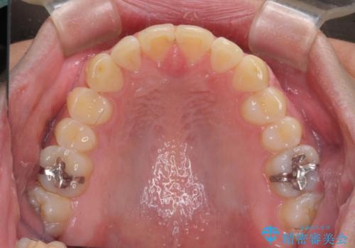 気になる前歯を治したい 短期間でのインビザライン矯正の治療中