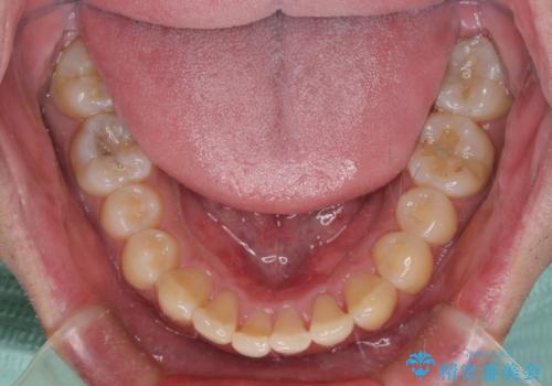 気になる前歯を治したい　短期間でのインビザライン矯正の治療中