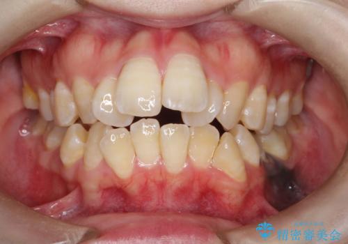 重度のガタガタ ワイヤーによる抜歯矯正