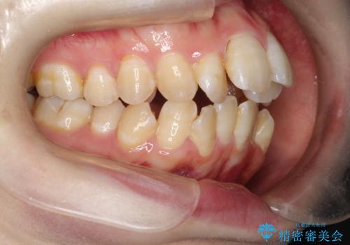 重度のガタガタ ワイヤーによる抜歯矯正の症例 治療前