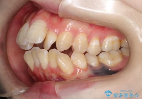 重度のガタガタ ワイヤーによる抜歯矯正の治療前