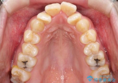 重度のガタガタ ワイヤーによる抜歯矯正の治療前