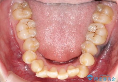 重度のガタガタ ワイヤーによる抜歯矯正の治療前