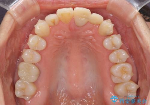 口元の突出感を治したい　治療中の歯も治したいの治療中