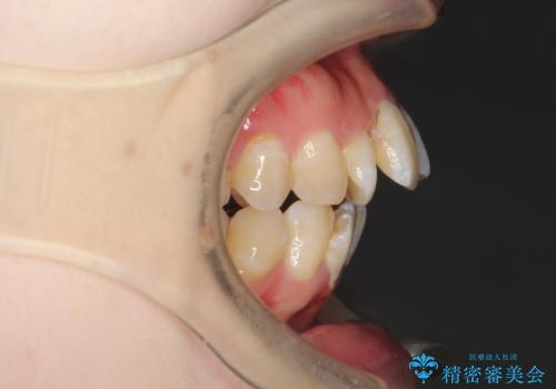 重度のガタガタ ワイヤーによる抜歯矯正の治療前