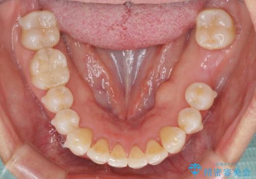 口元の突出感を治したい　治療中の歯も治したいの治療中