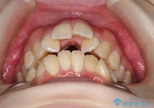 重度のガタガタ ワイヤーによる抜歯矯正の治療前