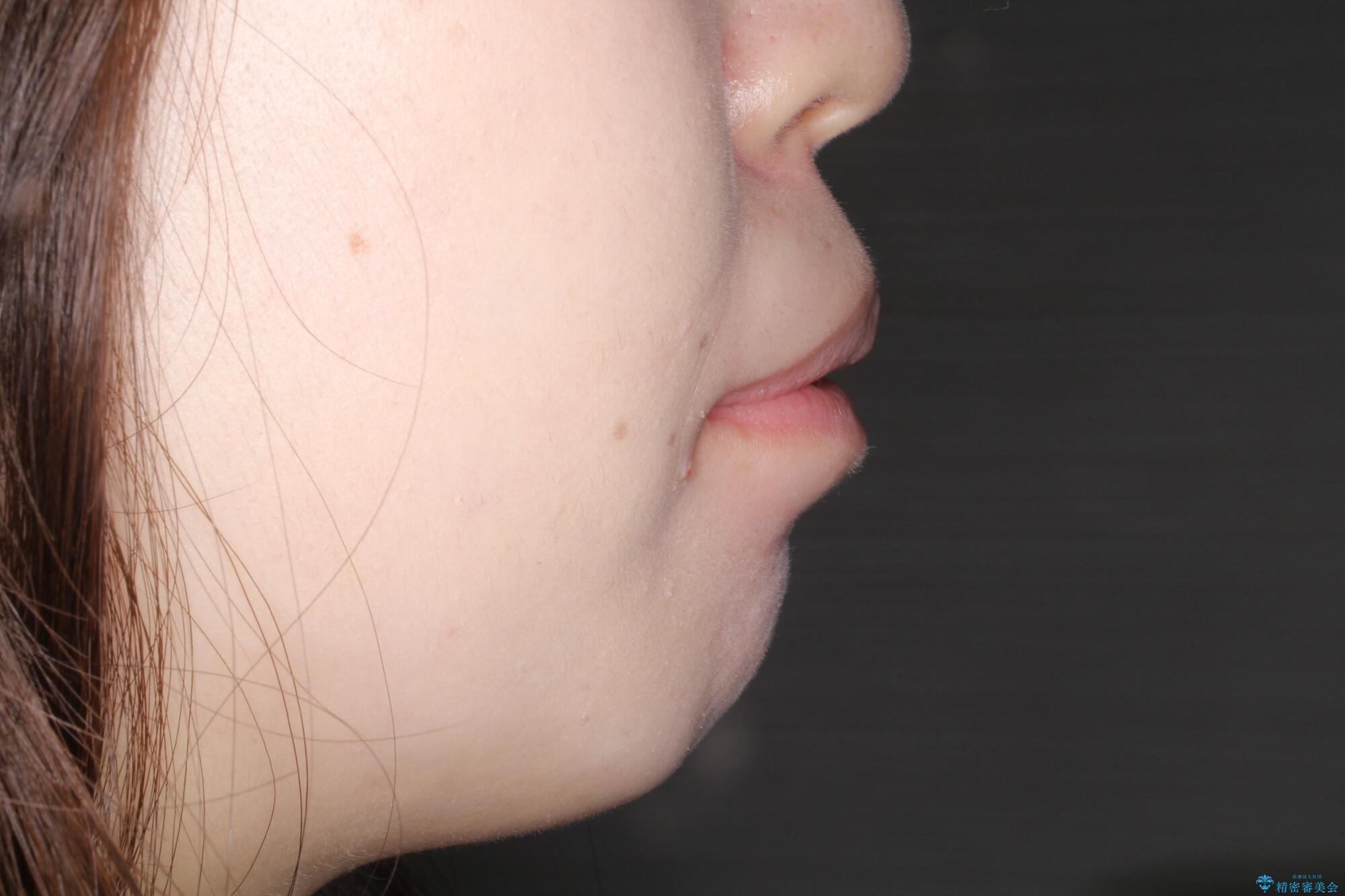 重度のガタガタ ワイヤーによる抜歯矯正の治療前(顔貌)