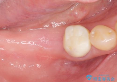 奥歯が割れている 抜歯してインプラントへ 40代女性の治療中