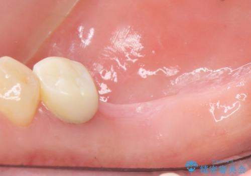 奥歯が割れている 抜歯してインプラントへ 40代女性の治療前