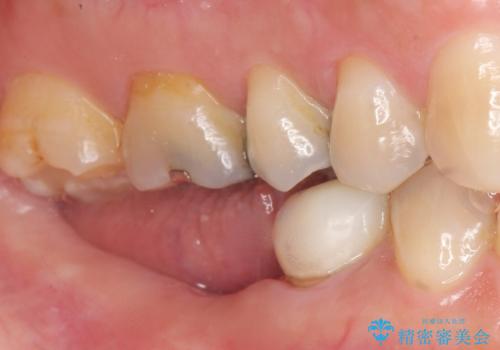 奥歯が割れている 抜歯してインプラントへ 40代女性の治療前