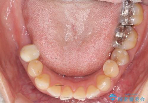 奥歯が割れている 抜歯してインプラントへ 40代女性の治療前
