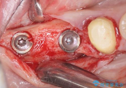 奥歯が割れている 抜歯してインプラントへ 40代女性の治療中