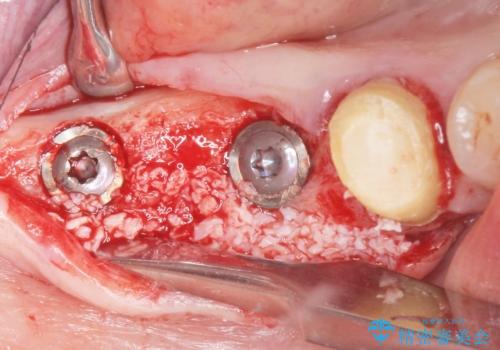 奥歯が割れている 抜歯してインプラントへ 40代女性