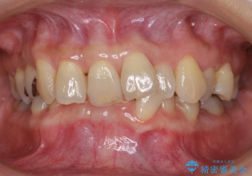 50代女性 インビザライン かみ合わせが深く、難しい症例