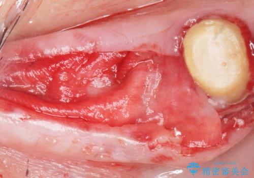 奥歯が割れている 抜歯してインプラントへ 40代女性の治療中